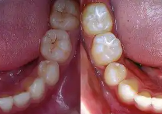 窩溝封閉、涂氟防蛀